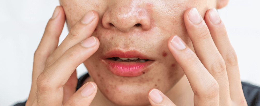 Why Is My Face So Oily? How to Treat Oily Skin?